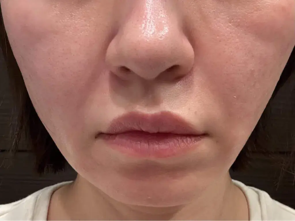 ほうれい線や目の下のたるみがスッキリしたのが分かる画像