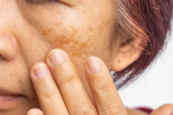 色素沈着を引き起こす可能性がある